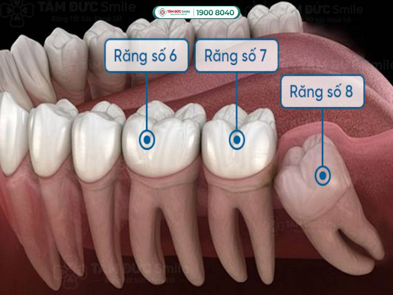 áp xe răng số 7 phải làm sao