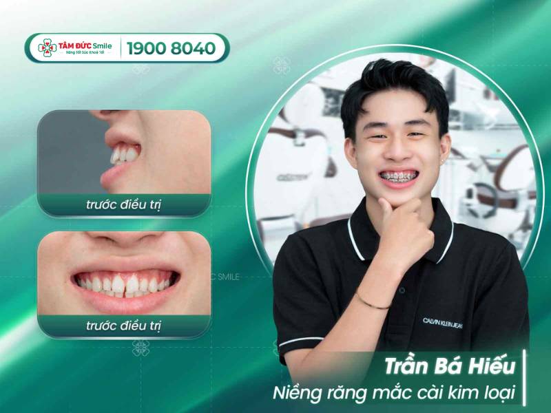 địa chỉ niềng răng ở Đà Nẵng uy tín