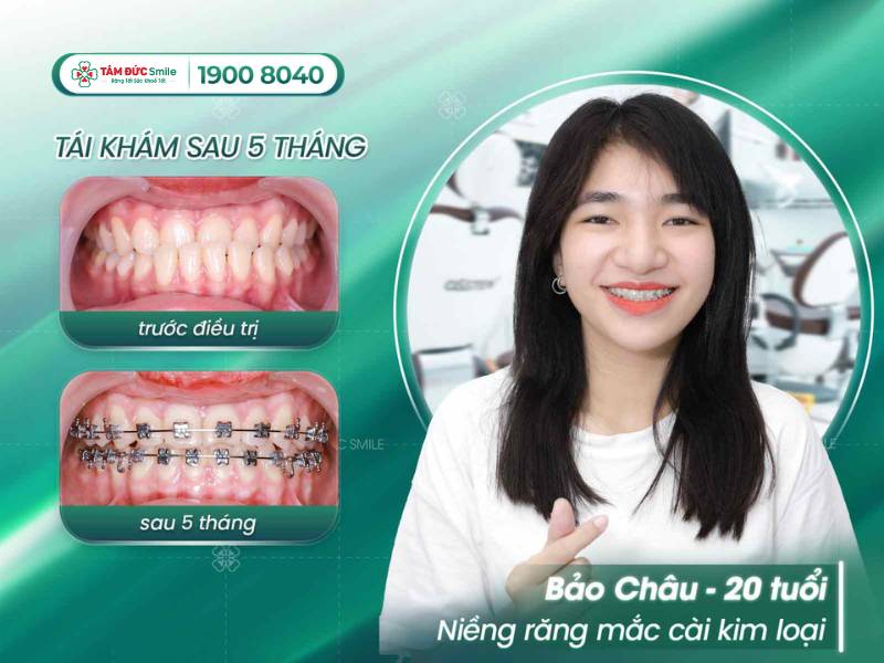 địa chỉ niềng răng ở Đà Nẵng uy tín