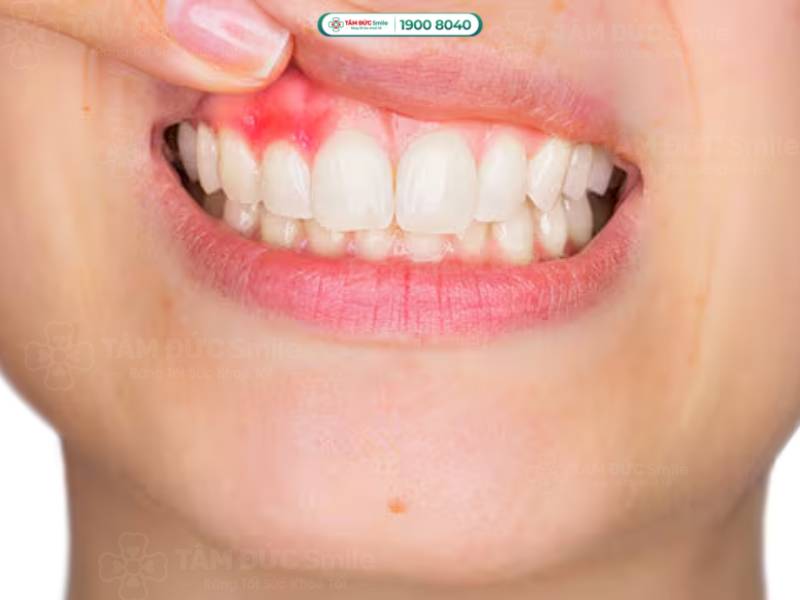 nướu răng bị sưng có phải dấu hiệu nguy hiểm không