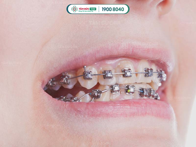 Niềng răng giúp dịch chuyển khớp cắn về trạng thái chuẩn, cải thiện xương hàm bên to bên nhỏ